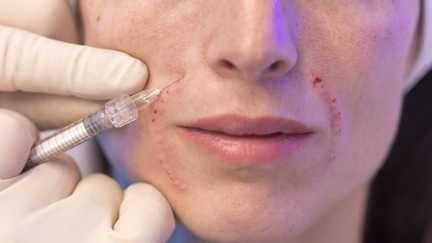 Stéphanie Rist déplore un « drame » après la mort d’une femme ayant reçu des injections clandestines de botox